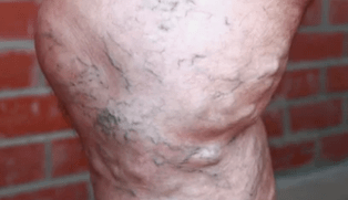 stades de développement des varices chez les hommes